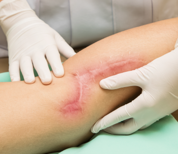 Wound Pain