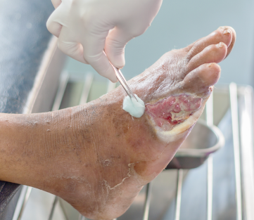 Debridement