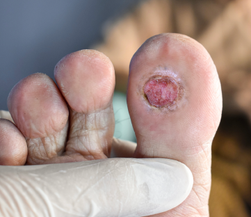 Diabetic Foot Ulcers 0-30 days