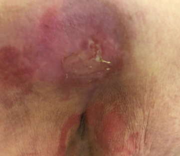Pressure Injuries / Prevention