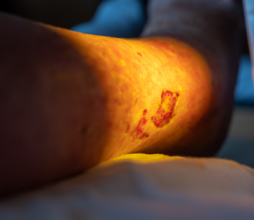 Venous Leg Ulcers 0-30 Days