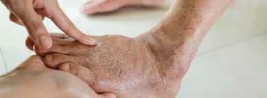 Peripheral Arterial Disease
