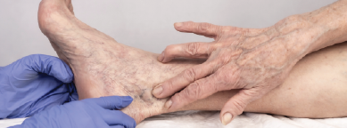 Diabetic Foot Ulcers 0-30 days
