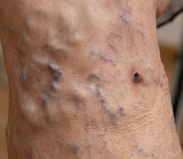 Treatment Interventions