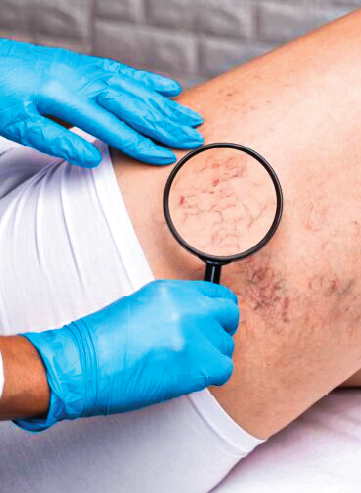Causes of Venous Leg Ulcers